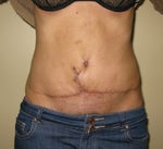 8 weeks after the operation